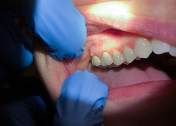 Best Emergency Dental Care for Broken or Chipped Teeth in Valencia, NM